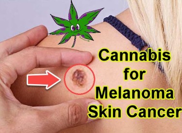 MARIJUANA FOR MELANOMA SKIN CANCER